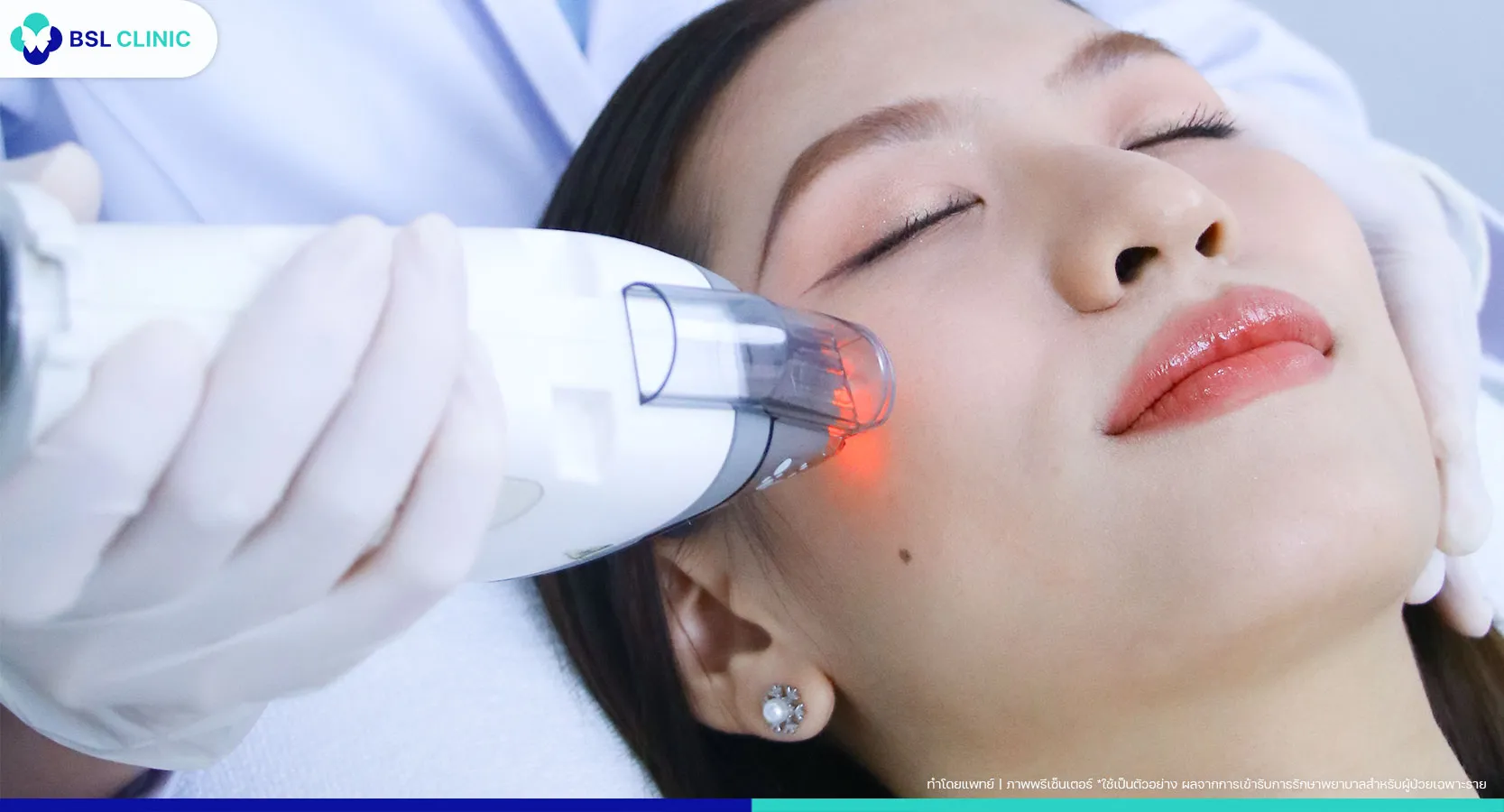 คลินิกรักษาสิวที่ไหนดี