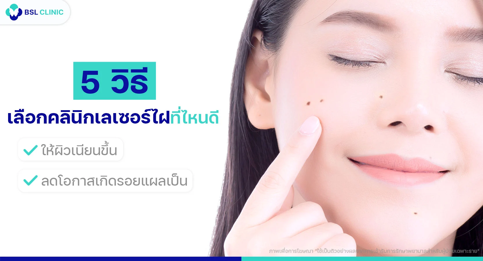 เลเซอร์ไฝที่ไหนดี