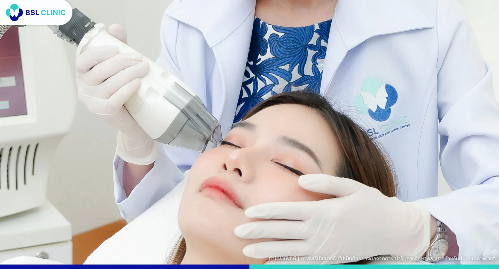 เลเซอร์ Fraxel Program