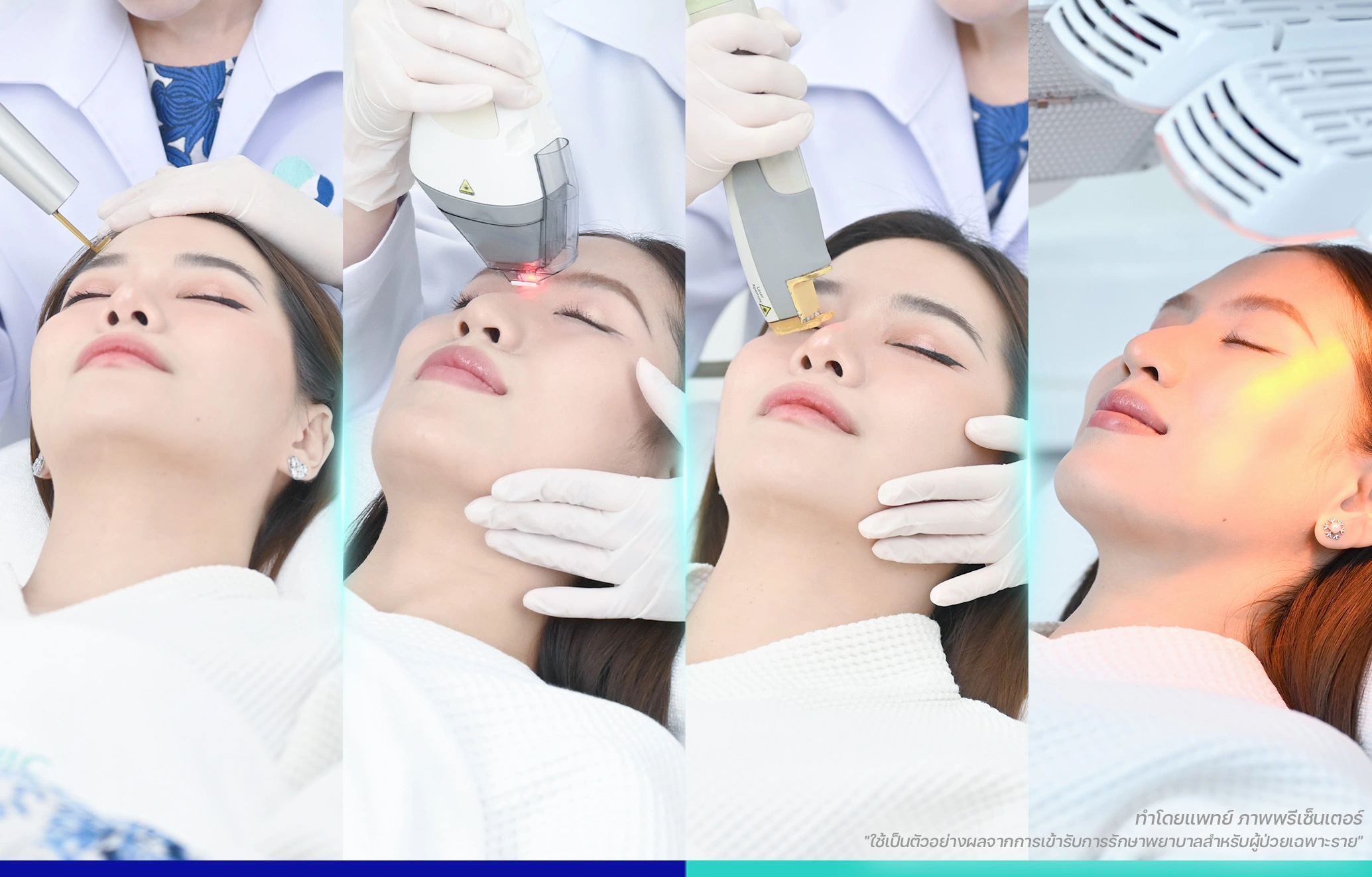 เลเซอร์หน้าใส