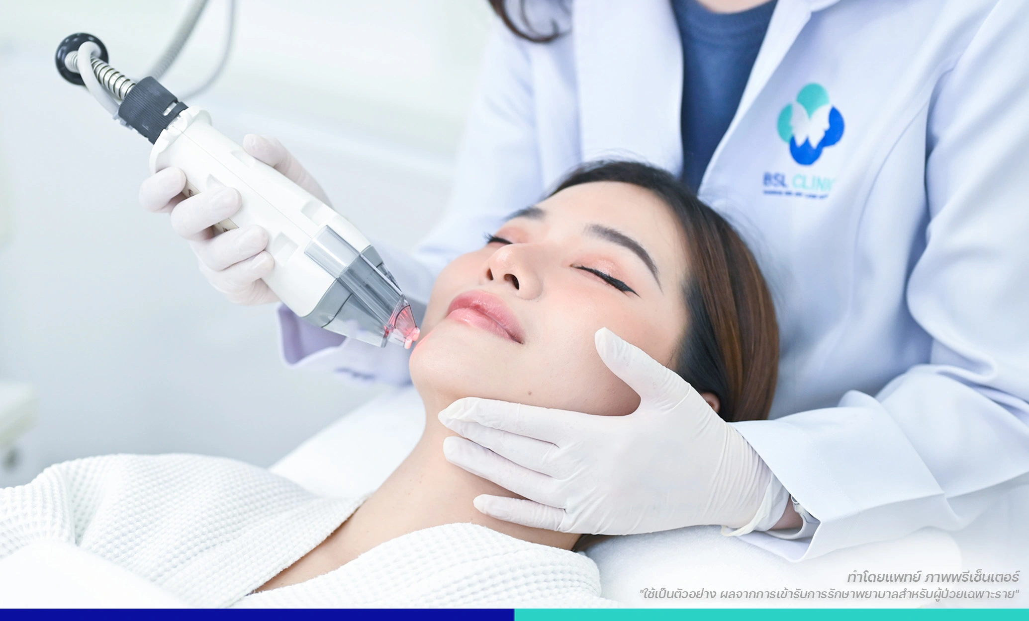 เลเซอร์ดึงเม็ดสี