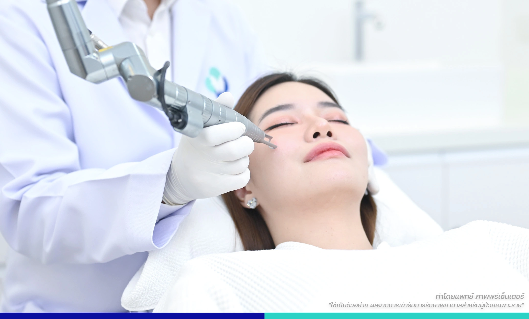 เลเซอร์ลดรอยดำ