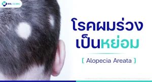 โรคผมร่วงเป็นหย่อม