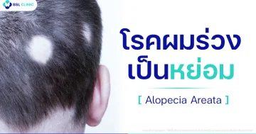 โรคผมร่วงเป็นหย่อม