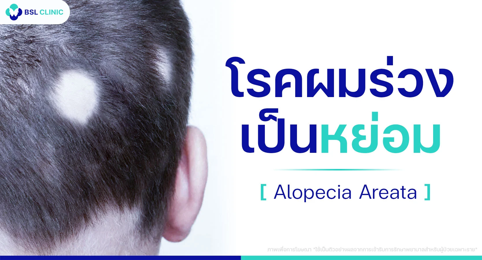 โรคผมร่วงเป็นหย่อม