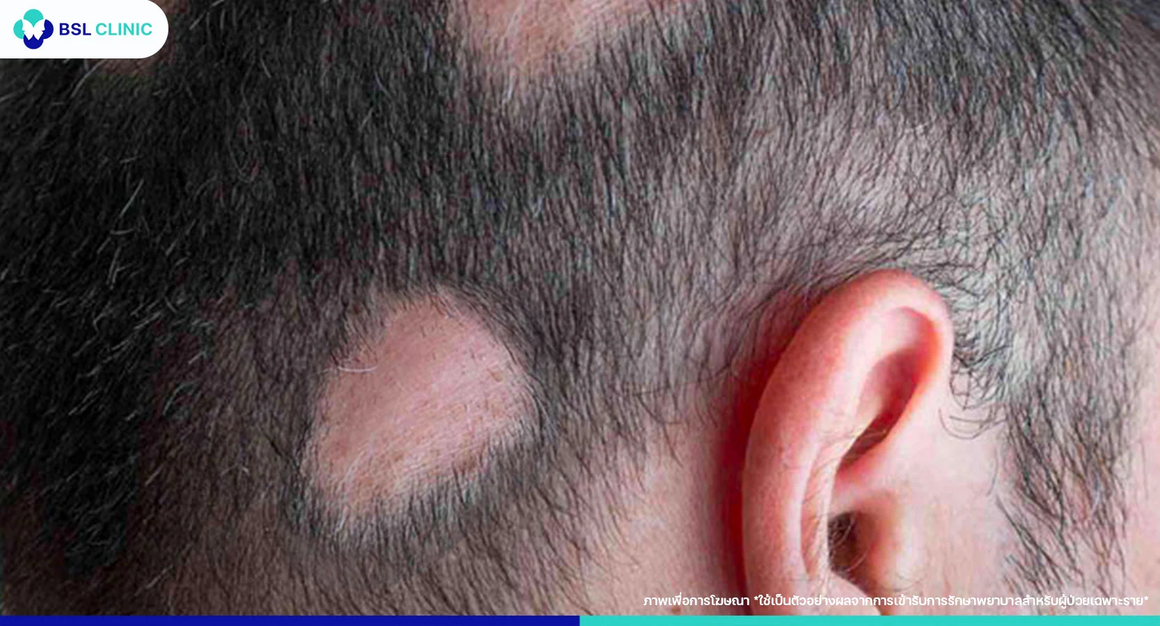 สาเหตุ โรคผมร่วงเป็นหย่อม