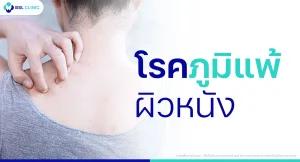 โรคภูมิแพ้ผิวหนัง