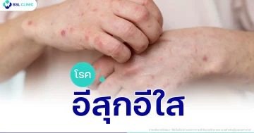 อีสุกอีใส