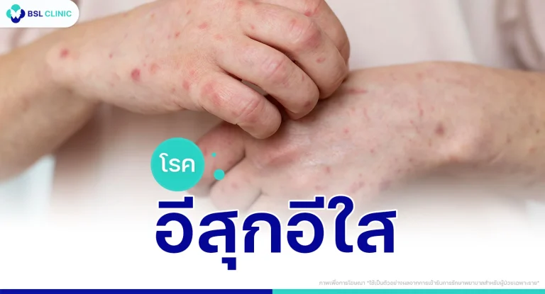 อีสุกอีใส