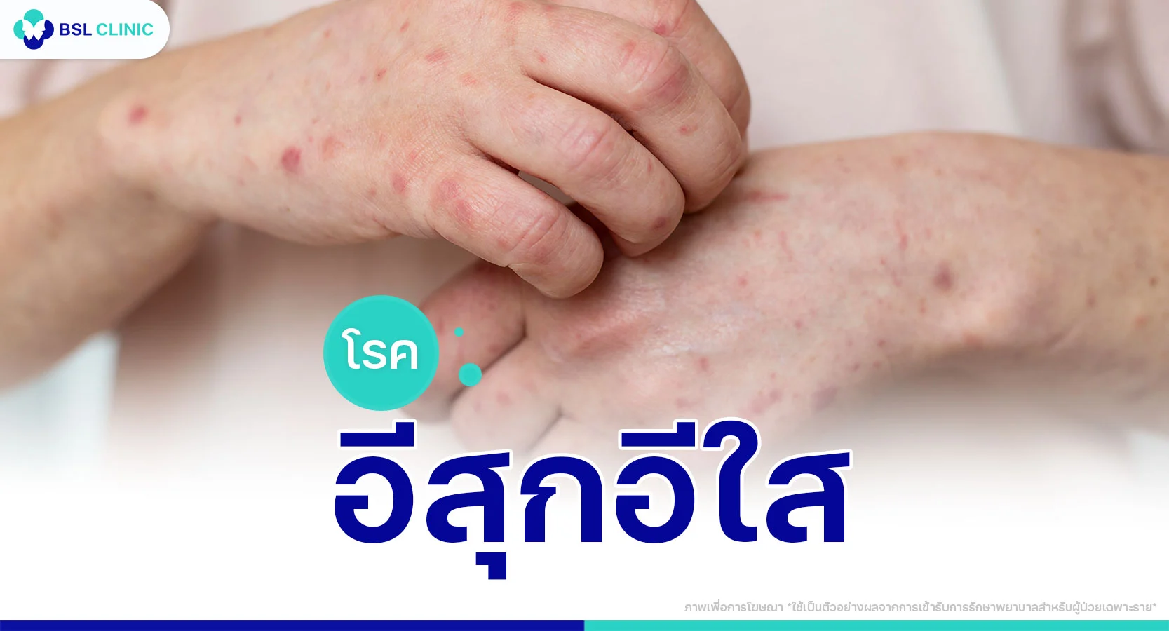 อีสุกอีใส