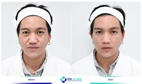 รีวิวยกกระชับปรับรูปหน้า