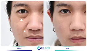 รีวิวยกกระชับปรับรูปหน้า