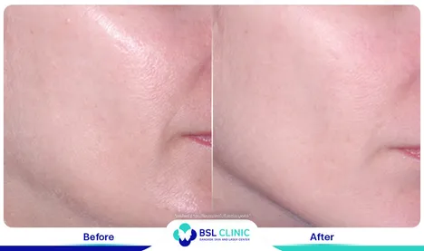 ยกกระชับหน้า