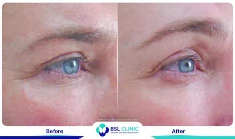 ยกกระชับหน้า