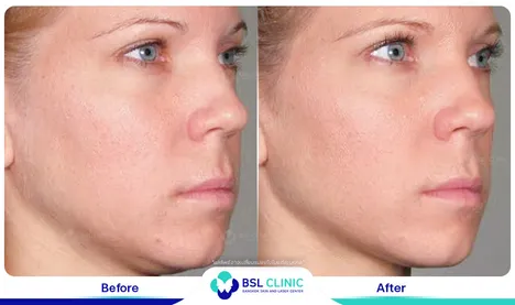 ยกกระชับหน้า