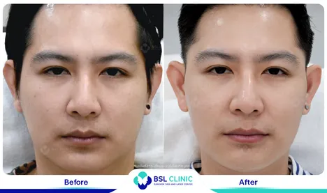 ยกกระชับหน้า