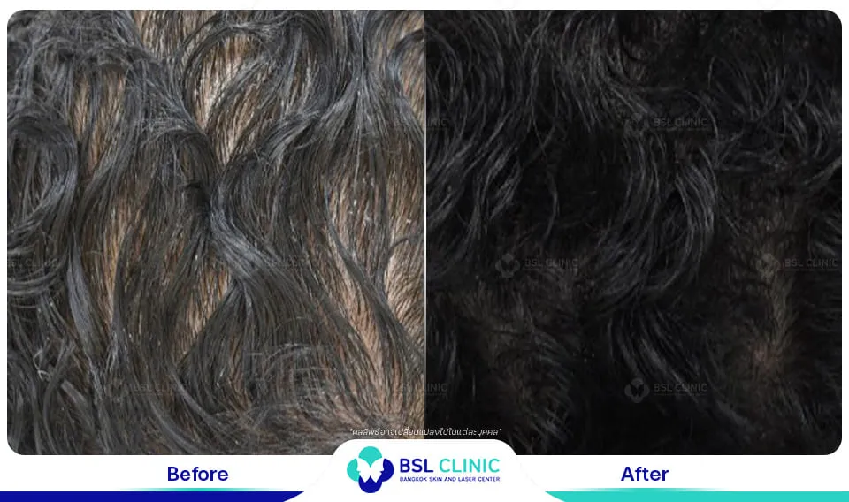 ภาพผลการรักษา ผมบาง ปลูกผมโดยไม่ต้องผ่าตัด