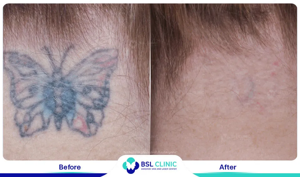 ภาพผลการรักษาลดรอยสัก