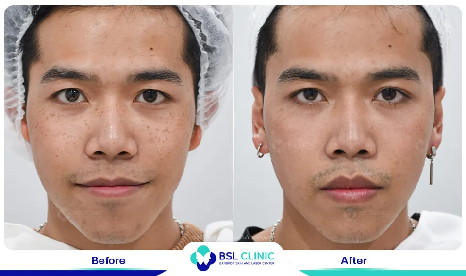 รีวิวรักษากระ