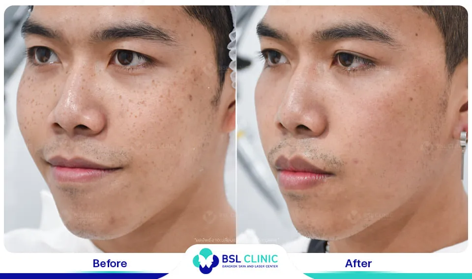 รีวิวรักษากระ