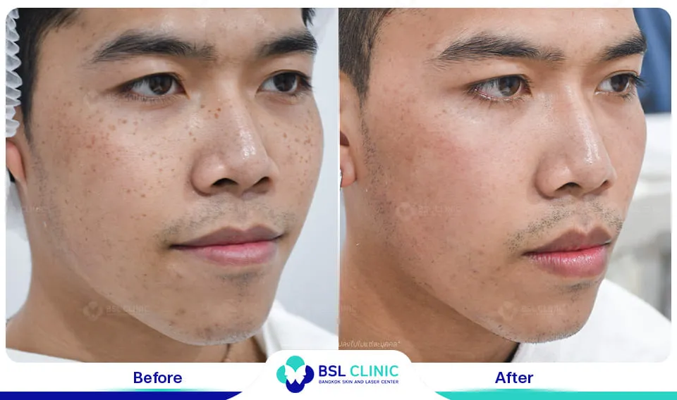 รีวิวรักษากระ