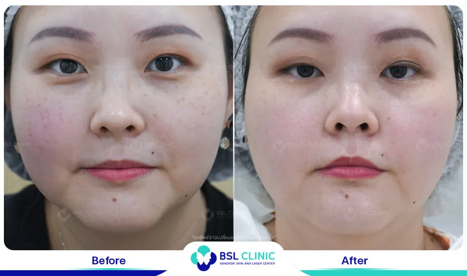 รีวิวรักษากระ