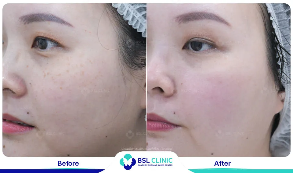 รีวิวรักษากระ