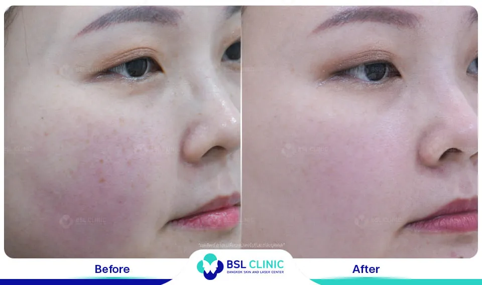 รีวิวรักษากระ