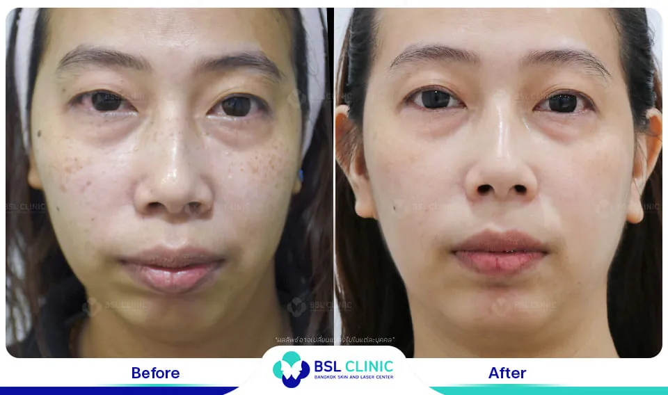 รีวิวรักษากระ