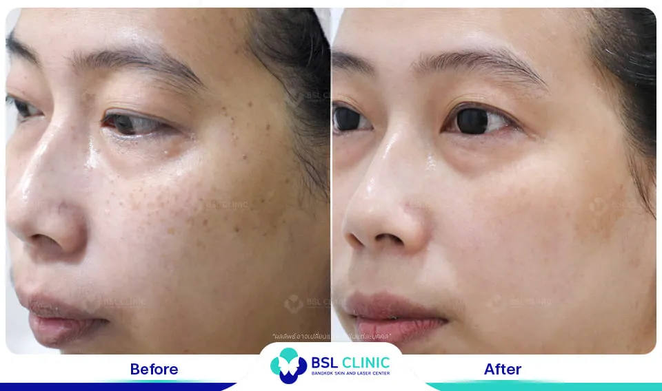 รีวิวรักษากระ