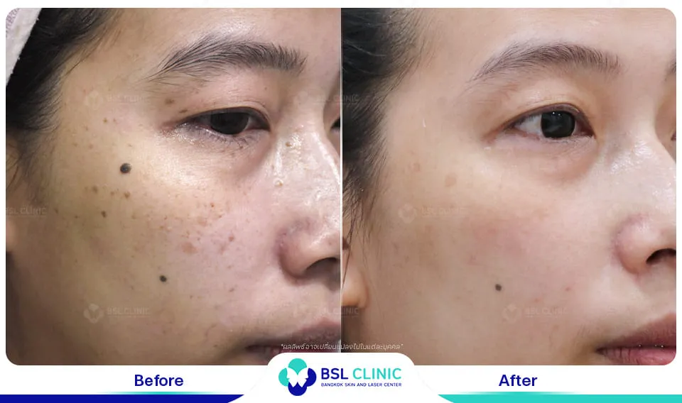 รีวิวรักษากระ