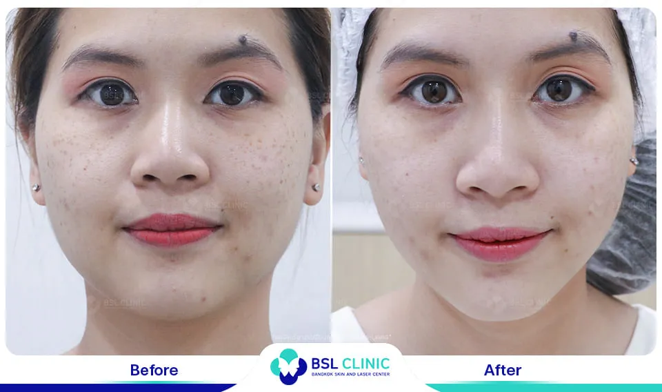 รีวิวรักษากระ