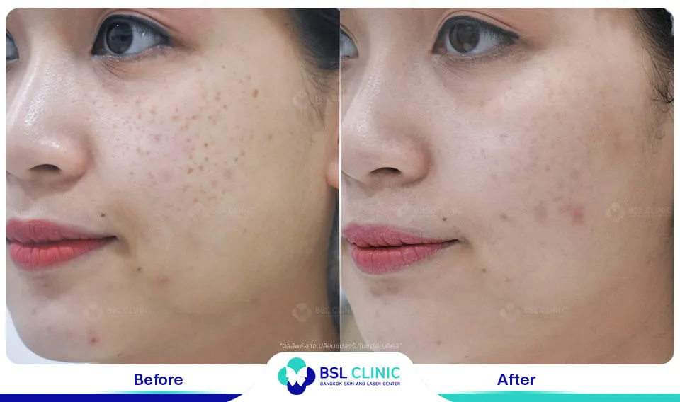 รีวิวรักษากระ