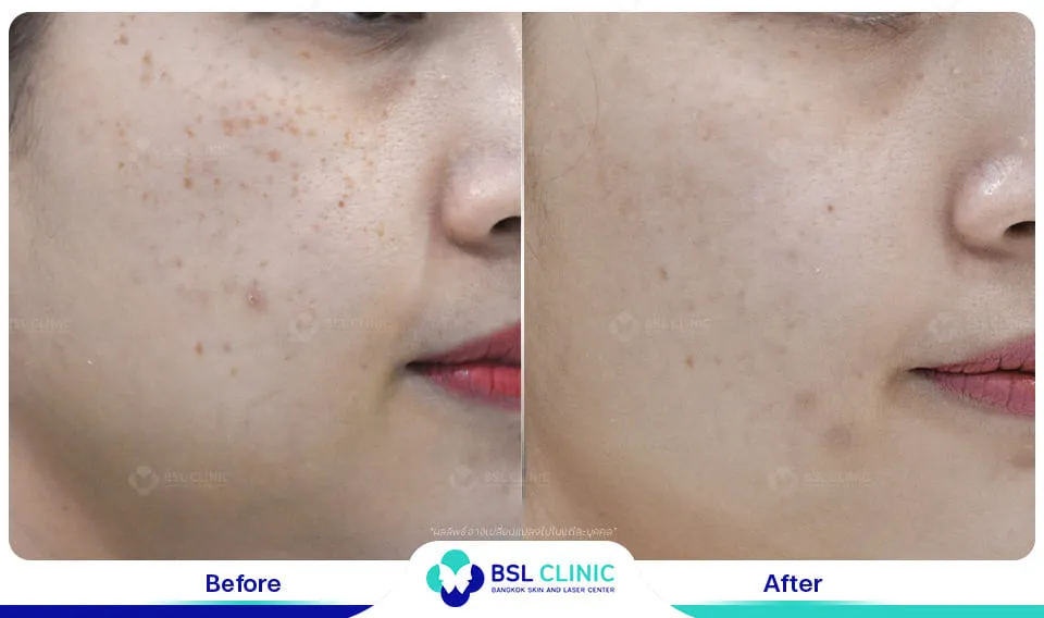 รีวิวรักษากระ