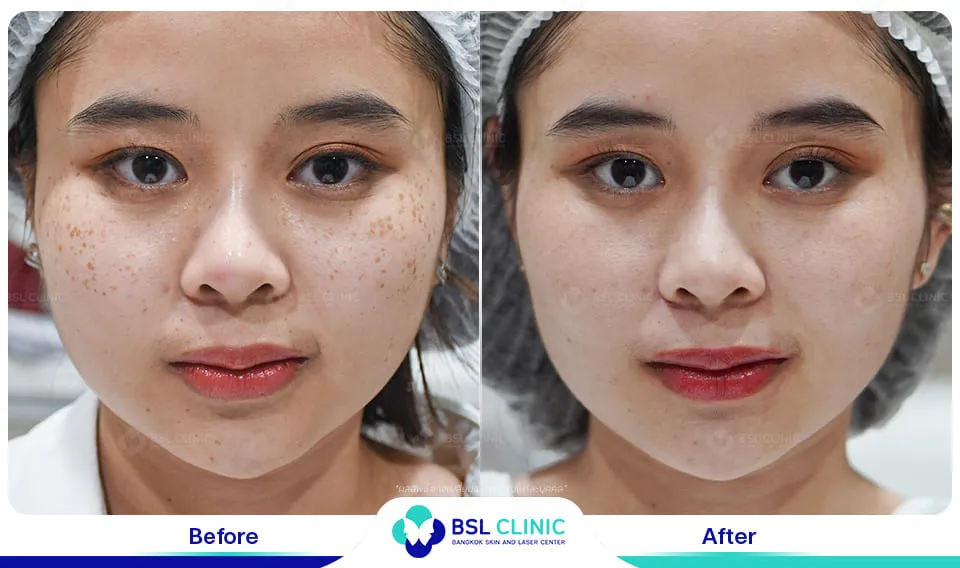 รีวิวรักษากระ