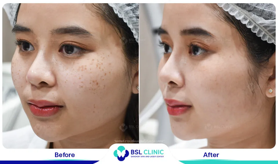 รีวิวรักษากระ