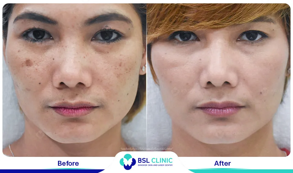 เลเซอร์รักษากระ