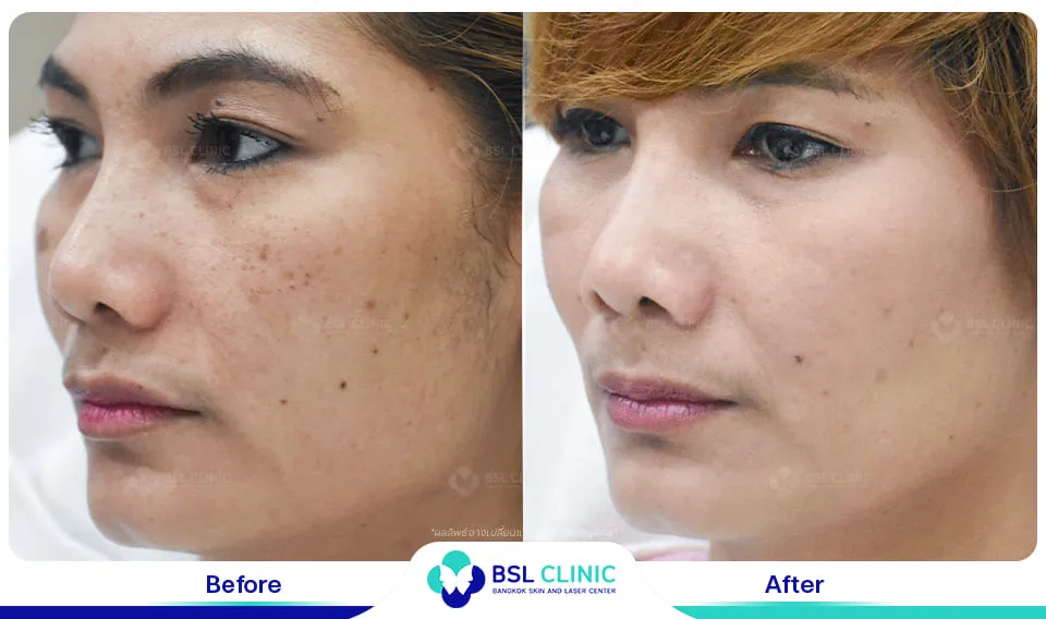 เลเซอร์รักษากระ