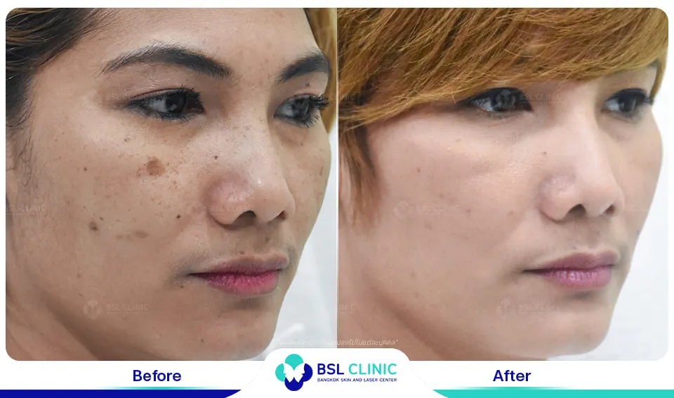 เลเซอร์รักษากระ