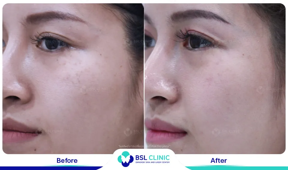 เลเซอร์รักษากระ