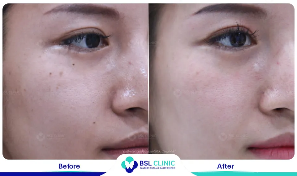 เลเซอร์รักษากระ