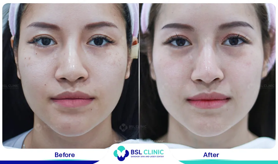 เลเซอร์รักษากระ