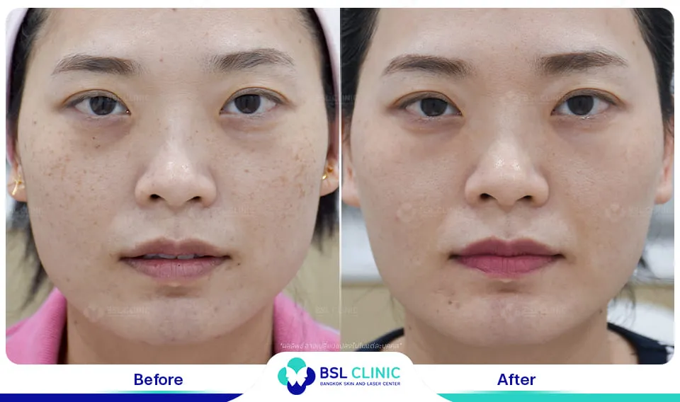 เลเซอร์รักษากระ