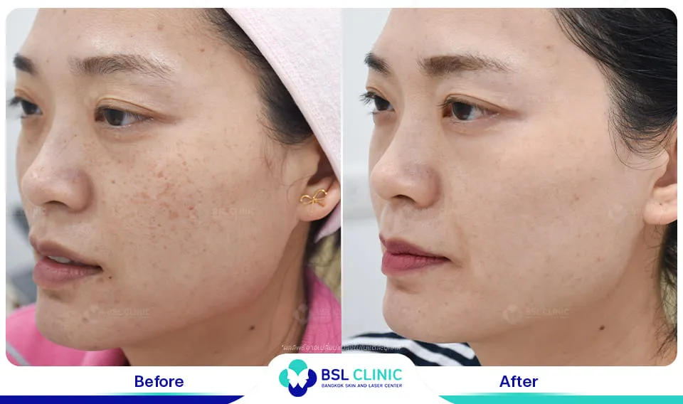 เลเซอร์รักษากระ