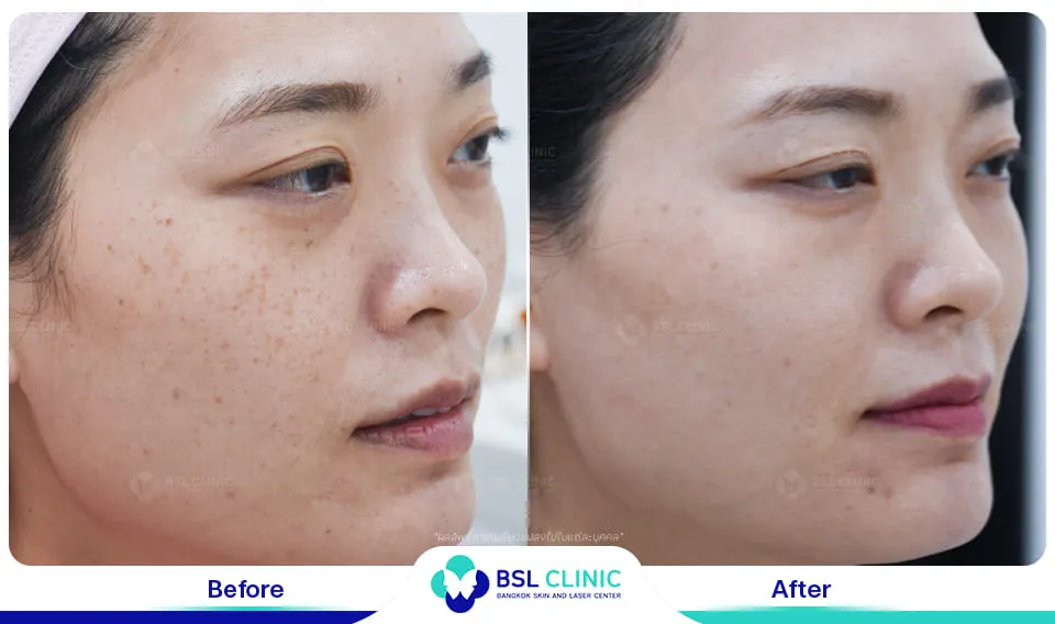 เลเซอร์รักษากระ