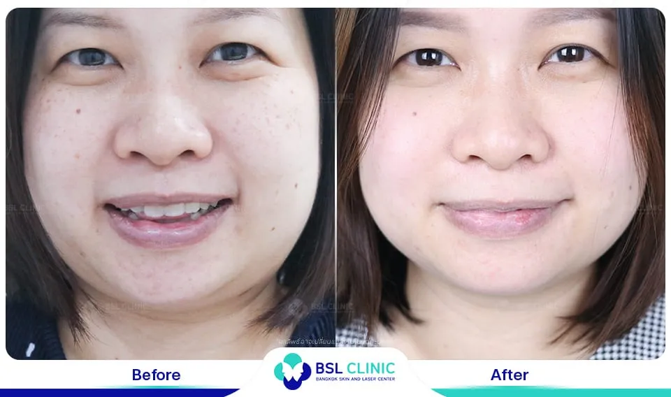 เลเซอร์รักษากระ