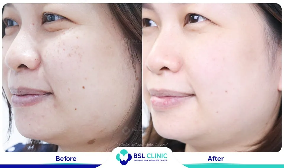 เลเซอร์รักษากระ