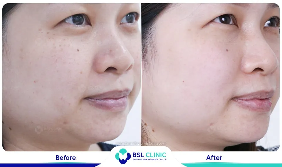 เลเซอร์รักษากระ