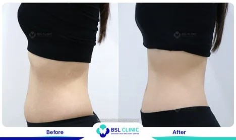 รีวิวลดไขมัน