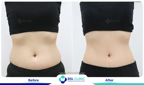 รีวิวลดไขมัน